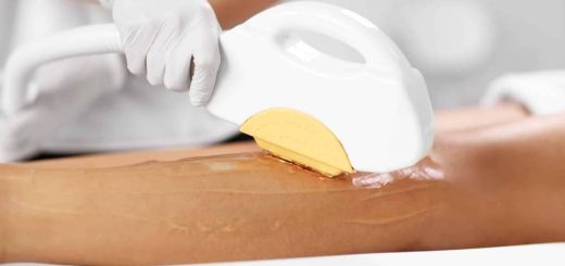 Why are people using IPL hair removal?