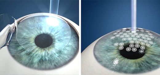 Benefits of ICL Surgery for Vision Correction